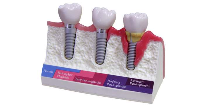 Treatment of Peri-implant Diseases