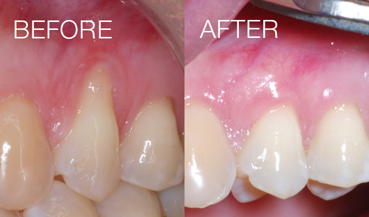 Soft Tissue Grafting