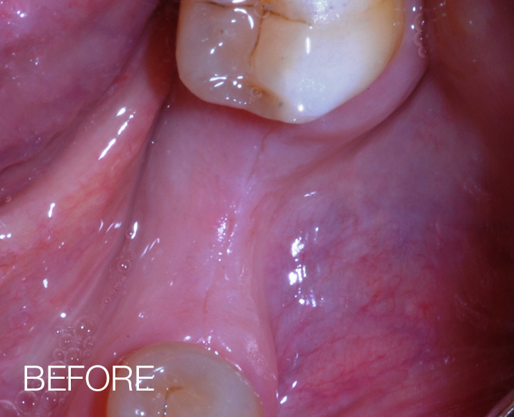 Bone Grafting Before