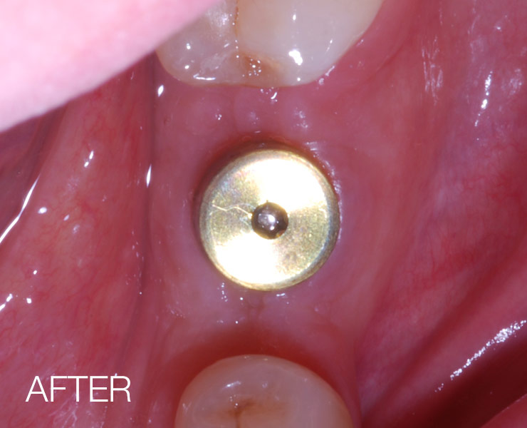 Bone Grafting After